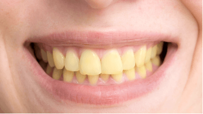 Jennifer L. before Teeth Whitening